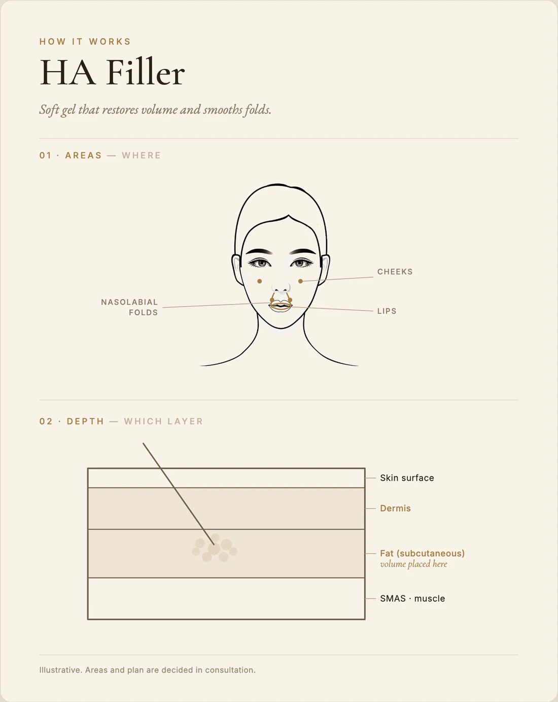 HA filler — how it works