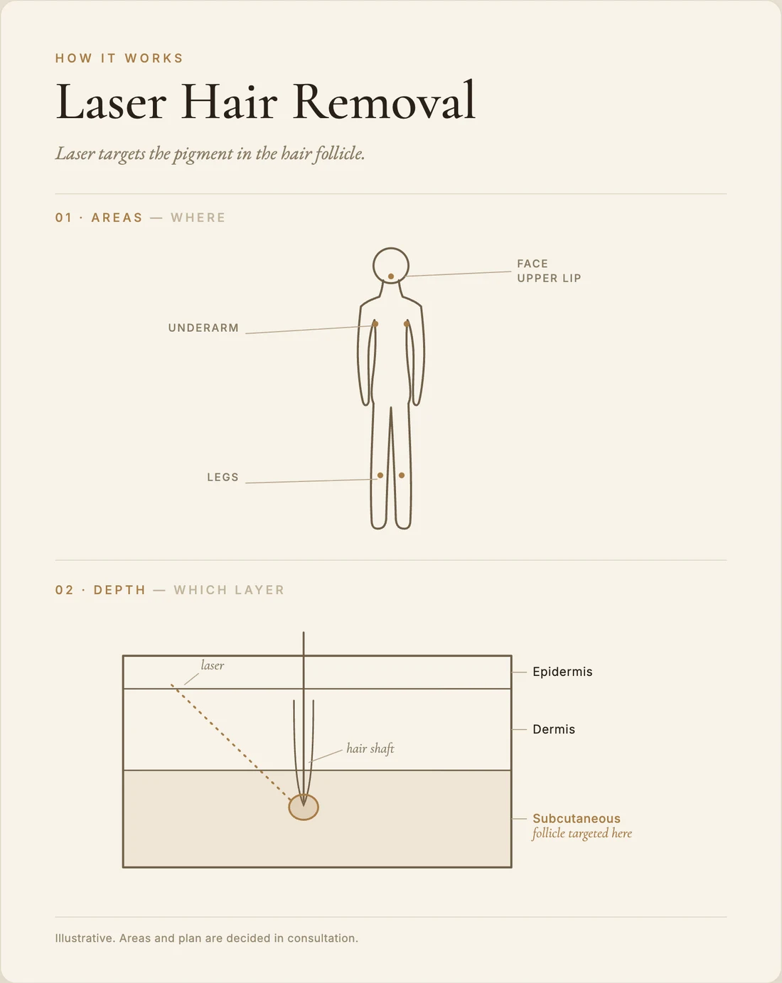 Laser hair removal — how it works