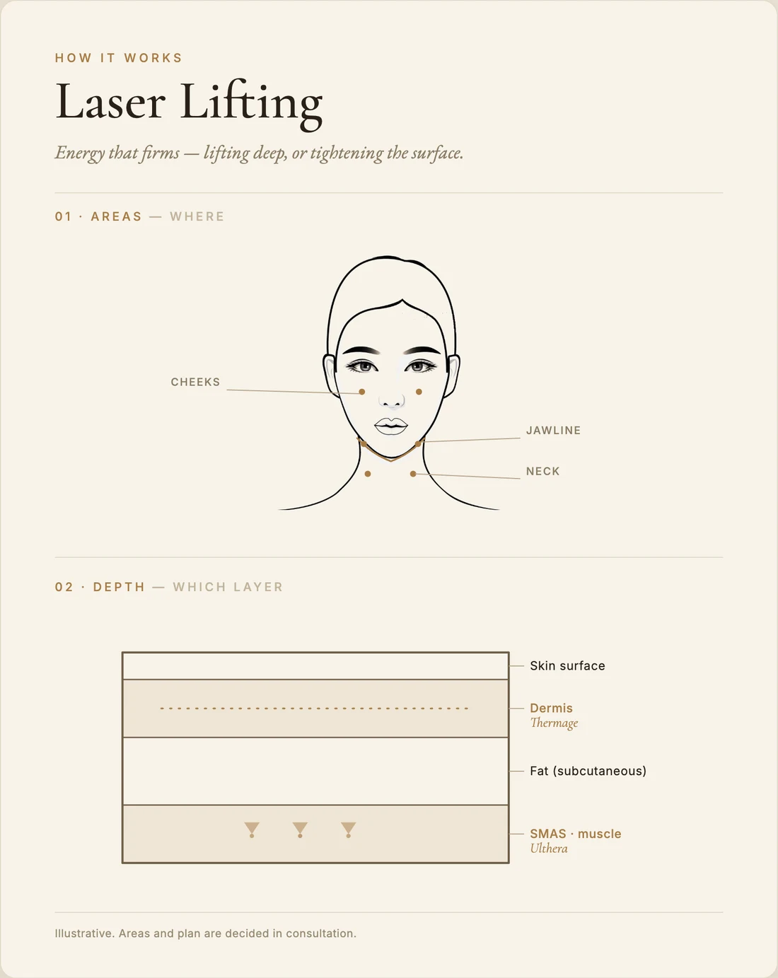 Laser lifting (Ulthera / Thermage) — how it works