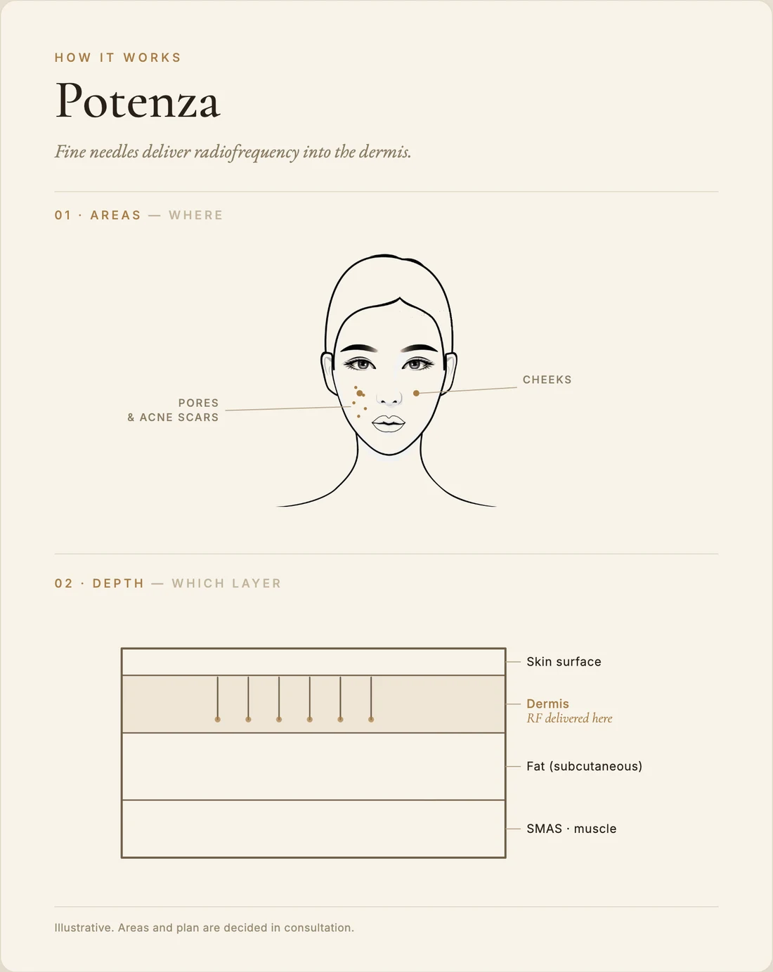 Potenza (RF microneedling) — how it works