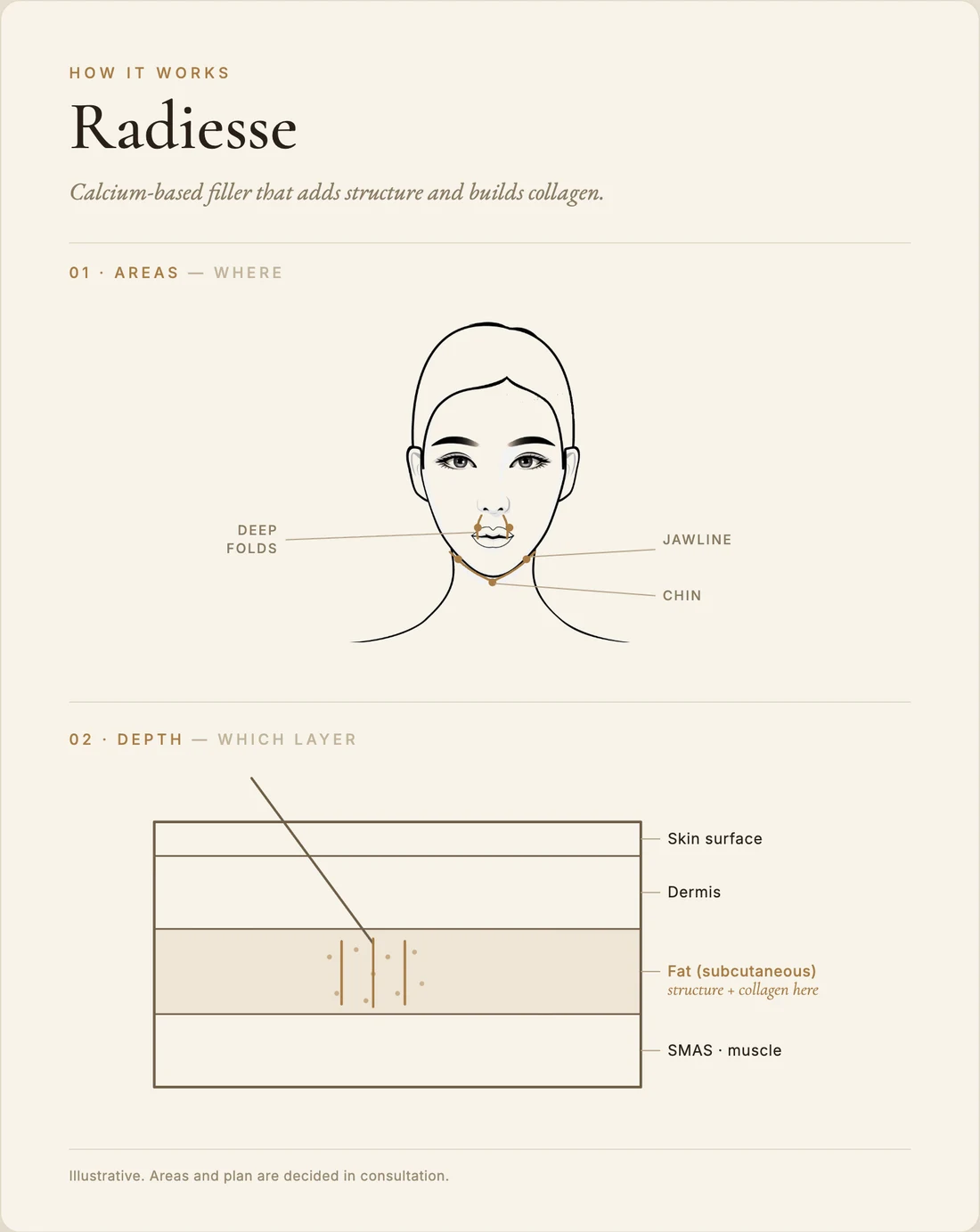 Radiesse — how it works
