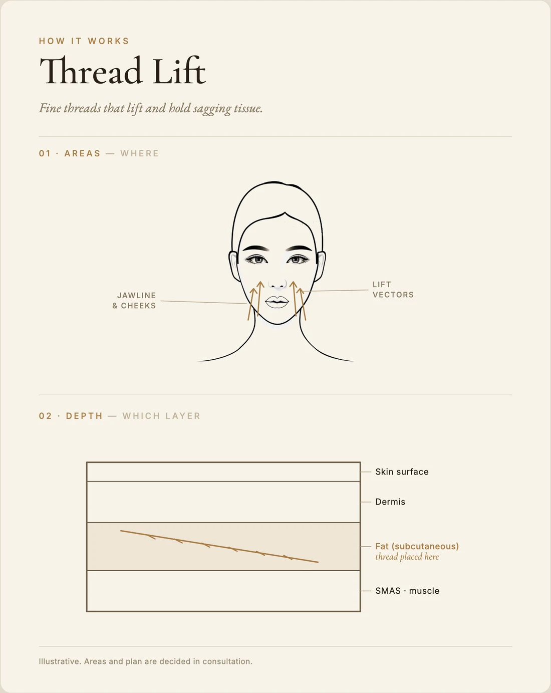 Thread lift (PDO / PCL) — how it works