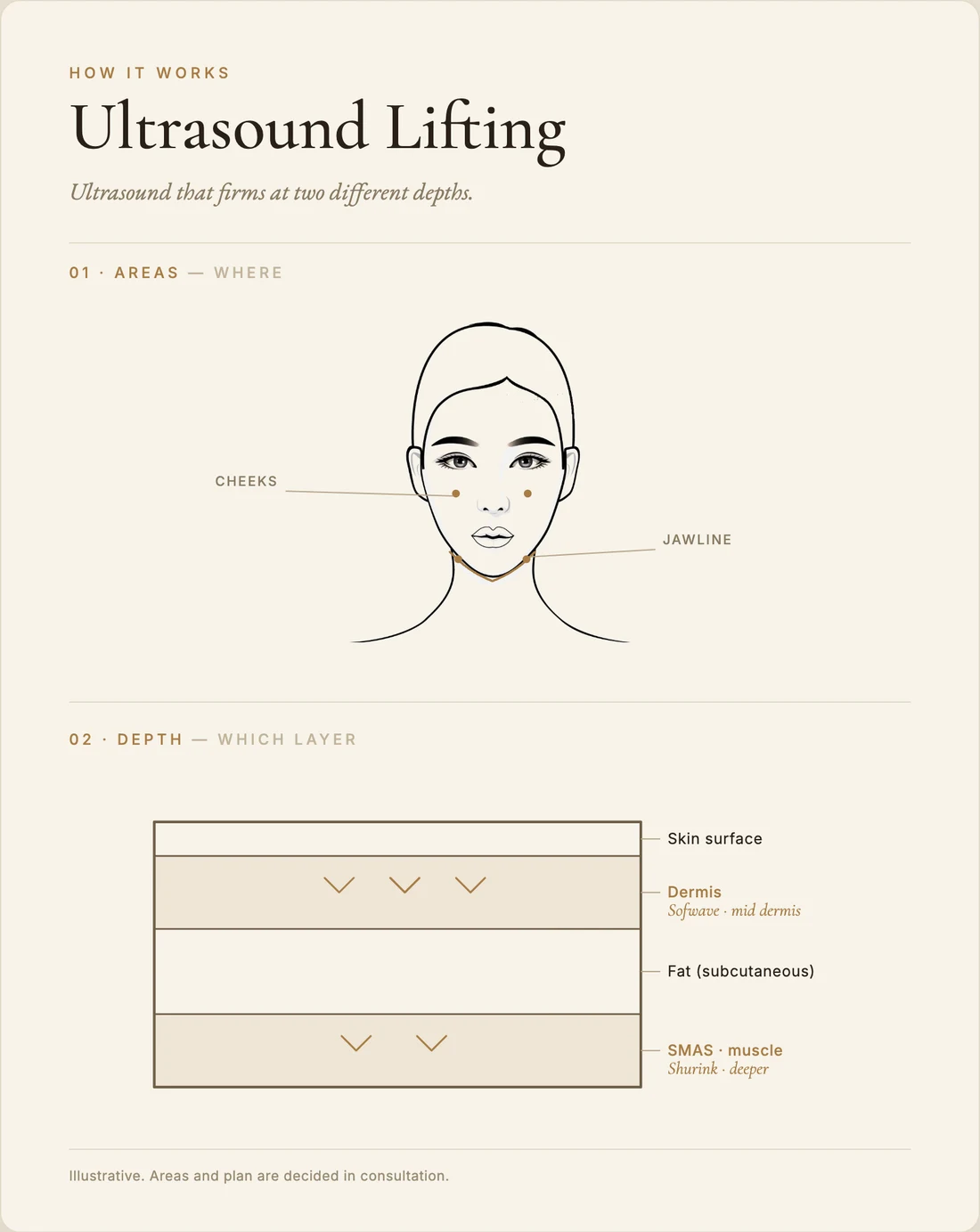 Ultrasound lifting (Shurink / Sofwave) — how it works